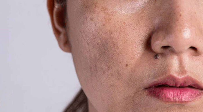 پوست آسیب دیده